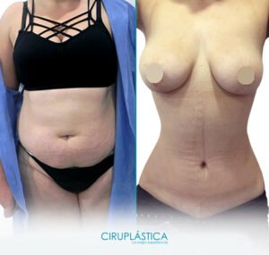 cicatriz después de una abdominoplastia